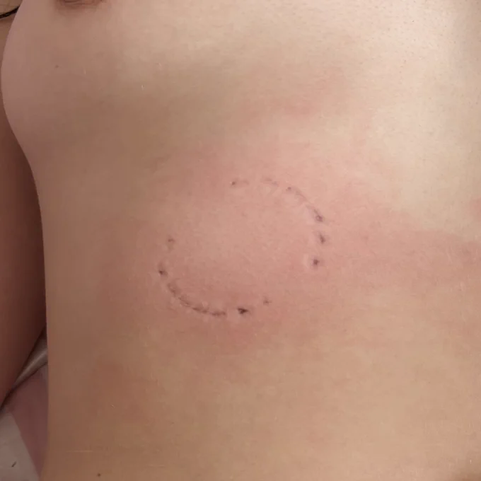 A picture of a bite mark in flesh