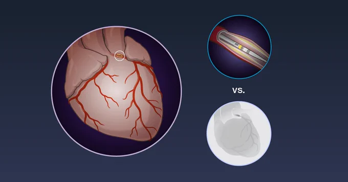 An illustration of a heart with visible arteries on the left. On the right are intravascular ultrasonography–guided PCI (top) and angiography-guided PCI (bottom) with the word "vs." between them.