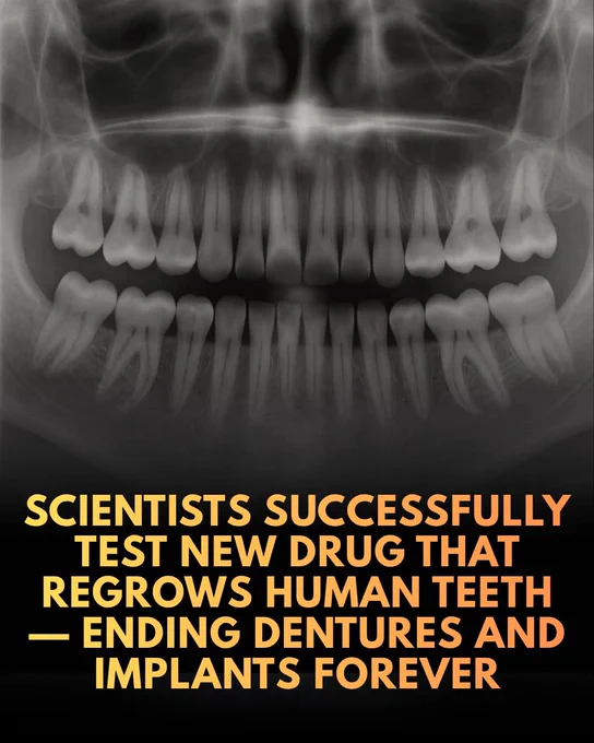 Scientists created a drug that lets humans regrow lost teeth naturally 🦷

Researchers in Japan, led by Dr. Katsu Takahashi at the Medical Research Institute Kitano Hospital, have developed a pioneering medication that stimulates the natural regrowth of teeth. 

The drug works by blocking a protein called USAG-1, which normally suppresses tooth development in humans. Having already successfully triggered the growth of brand-new teeth in mouse trials, the research team is now preparing to initiate human clinical trials, aiming to make this transformative treatment commercially available within the decade.

This innovative therapy builds on decades of regenerative medicine and the discovery that humans possess dormant, 'third set' tooth buds, much like sharks or elephants that naturally grow multiple sets of teeth. 

When combined with ongoing advances in bone and dental pulp regeneration, scientists believe this approach could eventually reverse tooth loss caused by genetics, injury.