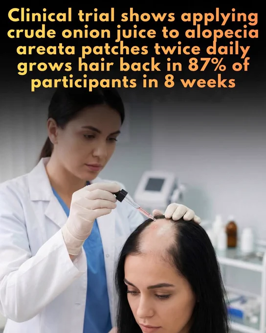 A study had an 87% success rate at reversing hair loss using the method.

A landmark study published in The Journal of Dermatology reveals that crude onion juice could be a surprisingly effective natural remedy for patchy alopecia areata. Researchers found that applying the juice twice daily led to significant hair regrowth in nearly 87% of participants within just six to eight weeks. Results were particularly striking among male participants, who saw a 93.7% success rate compared to 71.4% in women. This simple topical treatment significantly outperformed tap water, which served as the control group, marking a potential breakthrough for those seeking accessible, non-pharmaceutical options for hair restoration.

The science behind this unconventional method suggests that onion juice acts as a topical irritant. Experts believe this irritation triggers a localized response that diverts the body's autoimmune attack away from hair follicles, effectively allowing them to transition back.