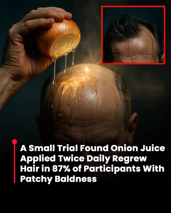 🧅 The Onion Juice Hair Regrowth Shock That Stunned Scientists

A small but fascinating clinical trial from 2002 revealed something almost unbelievable. People struggling with patchy hair loss applied simple onion juice to their scalp—and the results turned heads. Hair regrowth began in as little as two weeks, and by eight weeks, many participants experienced full recovery.