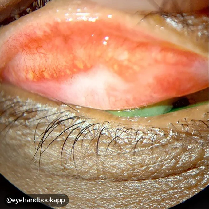 A patient presented with complaints of pricking sensation and pain in the eye. How would you manage this case?

Make your job as an eye care professional easier with the #free Eye Handbook mobile app! Access calculators, forums, references, and information in seconds, right from your smartphone or tablet.

Available on Android & iOS:
https://onelink.to/eyehandbookapp