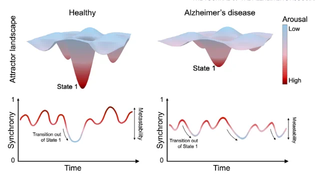 Schematic comparing a healthy brain and an Alzheimer’s brain. In health, the brain’s “attractor landscape” has deep wells, so dominant states such as State 1 are stable and synchrony swings widely over time. In Alzheimer’s, reduced arousal flattens the landscape, the dominant state becomes shallower, and synchrony is lower and less stable, with more frequent transitions out of State 1. Colour indicates arousal level, from low (blue) to high (red).