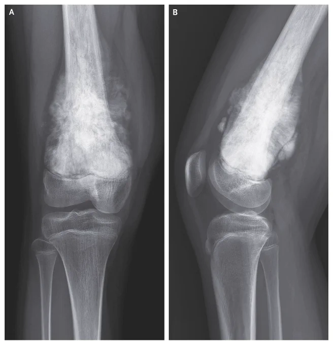 Radiographs of the knee showing a metaphyseal osteoblastic lesion with ill-defined margins and cortical destruction in the distal femur. At the top, "Images in Clinical Medicine" appears in white text inside an orange box, followed by the article title, which is "Osteosarcoma."