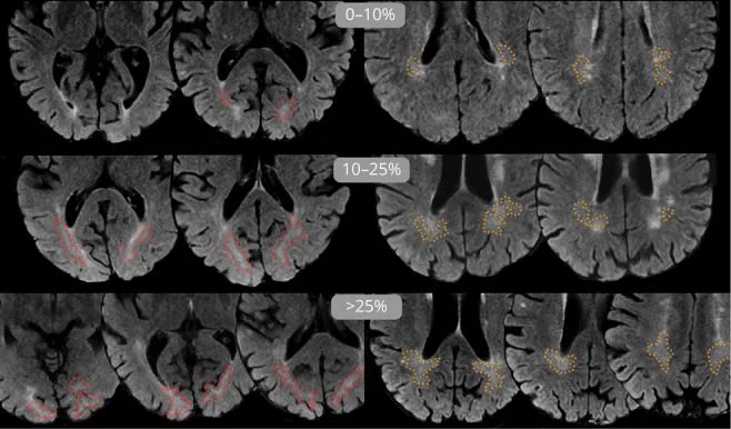Figure from Neurology paper on dirty-appearing white matter and dementia risk
