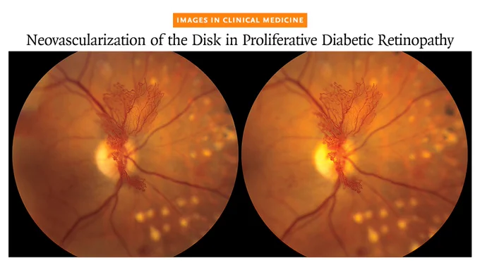 A patient’s stereo fundus photographs showing neovascularization of the disk extending out from the plane of the retina into the vitreous cavity. The article title, "Images in Clinical Medicine: Neovascularization of the Disk in Proliferative Diabetic Retinopathy," appears above them.