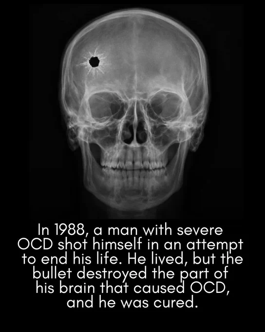 🚨 A man was shot in the head and cured of mental illness:

A 19-year-old man who attempted suicide by shooting himself in the head inadvertently cured his own severe, debilitating obsessive-compulsive disorder.

In 1983, a teenager identified only as George was trapped in a relentless cycle of severe obsessive-compulsive disorder (OCD), washing his hands hundreds of times a day and taking endless showers. 

Unable to cope with the debilitating illness, which had forced him to drop out of school and quit his job, George attempted to end his life by shooting himself in the head with a .22-caliber rifle.

 Remarkably, he survived. The bullet lodged in his brain's left frontal lobe, and while surgeons managed to remove most of it, some bullet fragments remained permanently embedded.

What followed puzzled and amazed his medical team: within three weeks of the incident, George’s obsessive-compulsive behaviors had virtually disappeared.