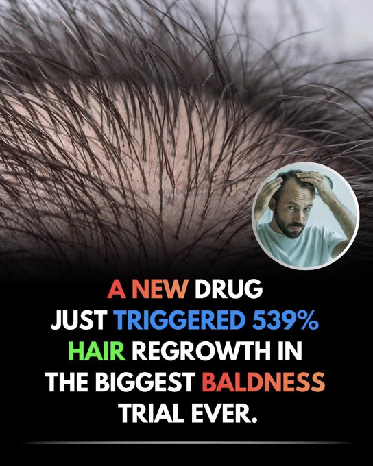 🚨 **A CURE FOR BALDNESS MAY BE CLOSER THAN EVER!** 

Scientists have revealed a new hair-loss treatment called **clascoterone**, and the results are turning heads. In major clinical trials, men using the treatment showed dramatically better hair growth than those using a placebo.

The drug works by blocking the hormone linked to hair loss directly at the hair follicle, offering a promising new approach that may have fewer side effects than current treatments.

If future safety reviews are successful, this breakthrough treatment could be available by 2027. Could this be the discovery millions have been waiting for?

Source:
Cosmo Pharmaceuticals. *Phase 3 SCALP clinical trial results*.; Gizmodo.; Healio Dermatology.