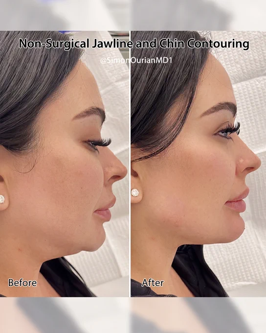 Non-surgical jawline and chin contouring by Dr. Simon Ourian at Epione