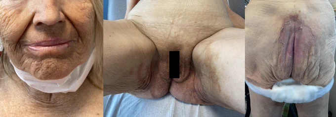 Near-complete resolution of necrolytic migratory erythema after treatment with a somatostatin analog.