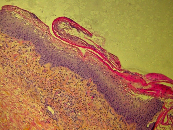 Skin biopsy demonstrating a central pale zone of necrolysis in the upper epidermis, with apoptotic and vacuolated keratinocytes under a superficial layer of parakeratosis (hematoxylin-eosin-saffron stain x100).