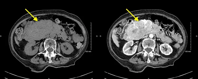 Contrast-enhanced abdominal CT scan showing a large, heterogeneous mass measuring 120 x 150 x 64 mm located in the pancreatic head. 