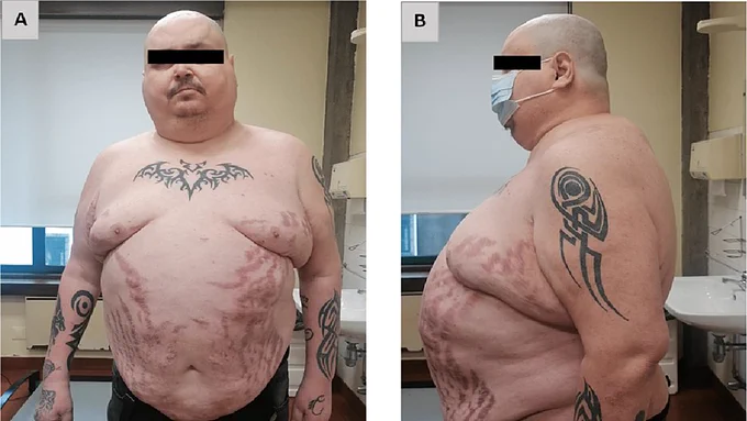 Benido Silva V, Cardoso J, Esteves Brandão M, et al. (January 30, 2023) Iatrogenic Cushing’s Syndrome: The Result of Cobicistat and Glucocorticoid Interaction in an HIV Patient After Bariatric Surgery. Cureus 15(1): e34367. doi:10.7759/cureus.34367