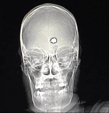 A man with severe OCD shot himself in an attempt to end his life. He lived, but the bullet destroyed the part of his brain that caused OCD, and he was cured.
