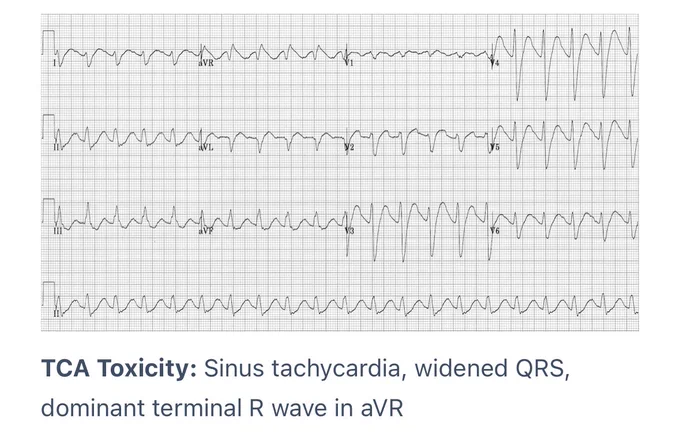 Intraventricular conduction delay: QRS > 100 ms in lead II
Terminal R wave > 3 mm in aVR or R/S ratio > 0.7 in aVR
Patients with tricyclic overdose will also usually demonstrate sinus tachycardia secondary to muscarinic (M1) receptor blockade
QT prolongation.  (Image source- litfl.com )